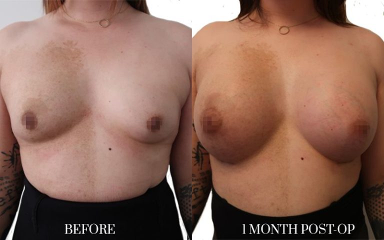 1-monthtrans-aumento-de-pecho-768x480