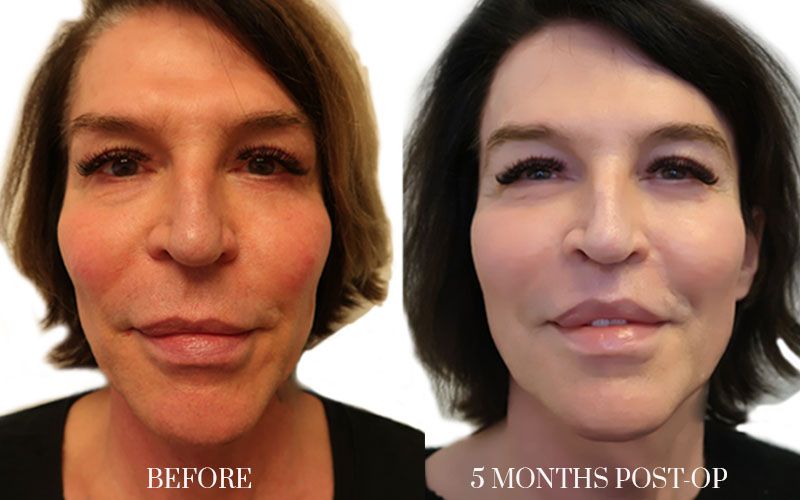 FEMINIZACION-FACIAL-3-WEB-FEMINIZACION-FACIAL