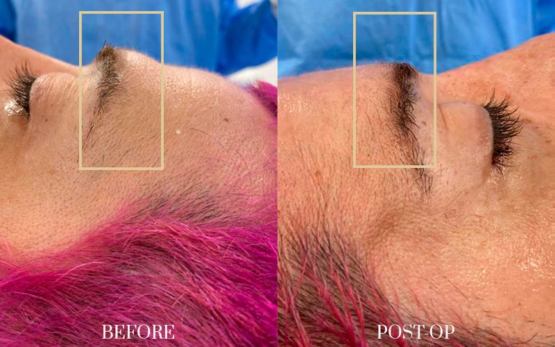 FEMINIZACIÓN-FACIAL