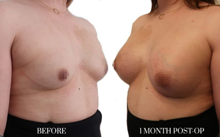 1-monthtrans-aumento-de-pecho-lateral-768x480-1 1