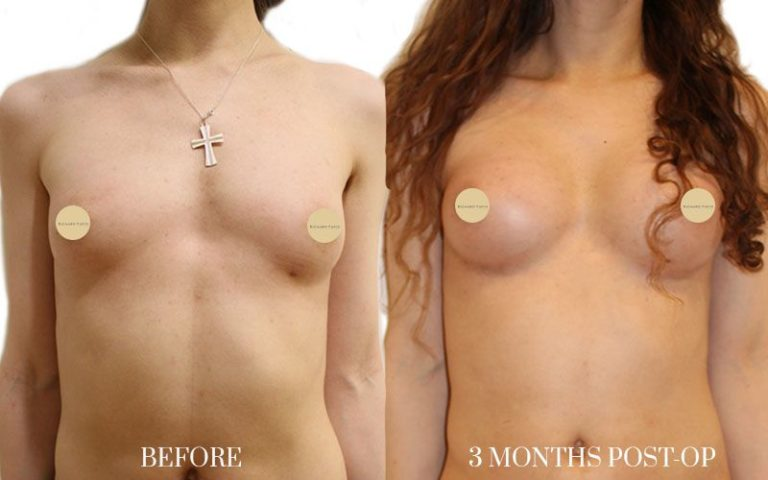 1AUMENTO-DE-MAMA-MUJERES-TRANS-frontal-768x480-1 1