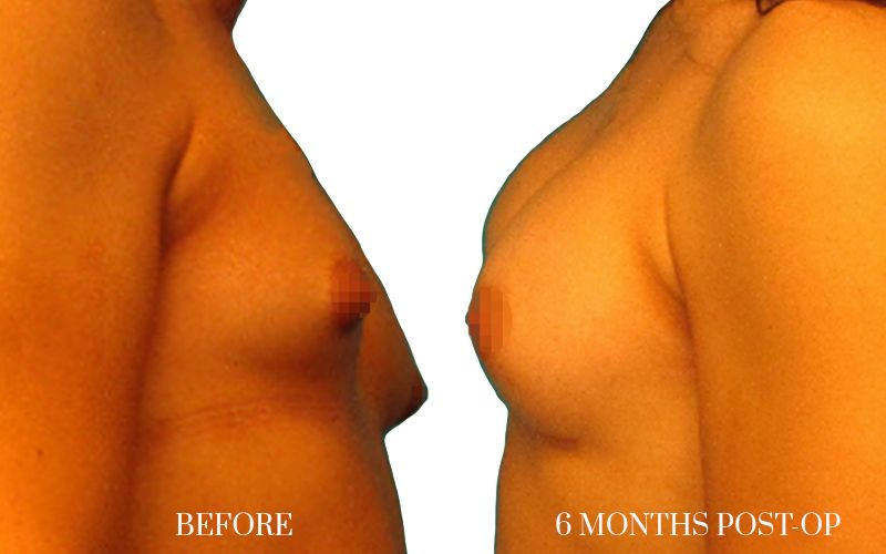 1AUMENTO-DE-PECHO-MUJER-TRANS-LATERAL 1