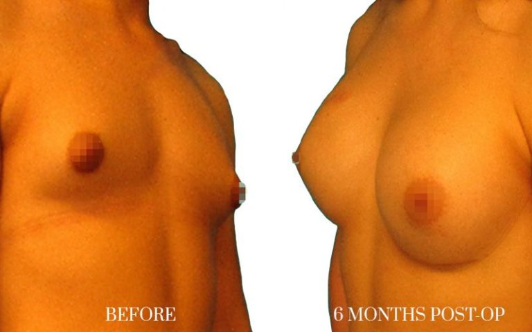 AUMENTO-DE-PECHO-MUJER-TRANS-LATERAL-768x480-1 1