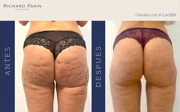 K-laser-celulitis-antes-y-despues 2