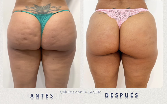 K-laser-celulitis-antes-y-despues