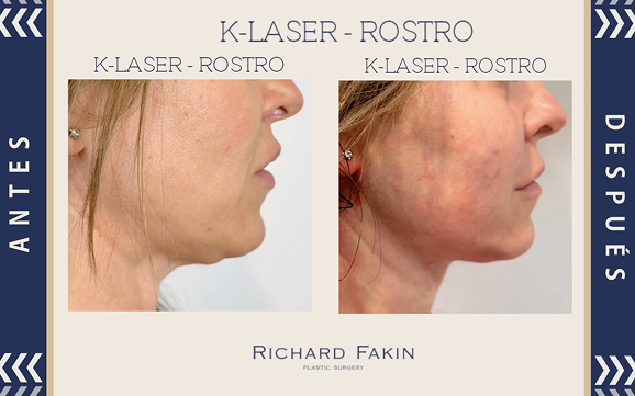 K-laser-papada-antes-y-despues 2