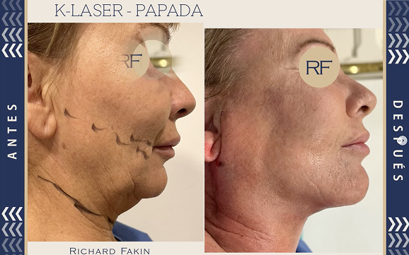 K-laser-papada-antes-y-despues