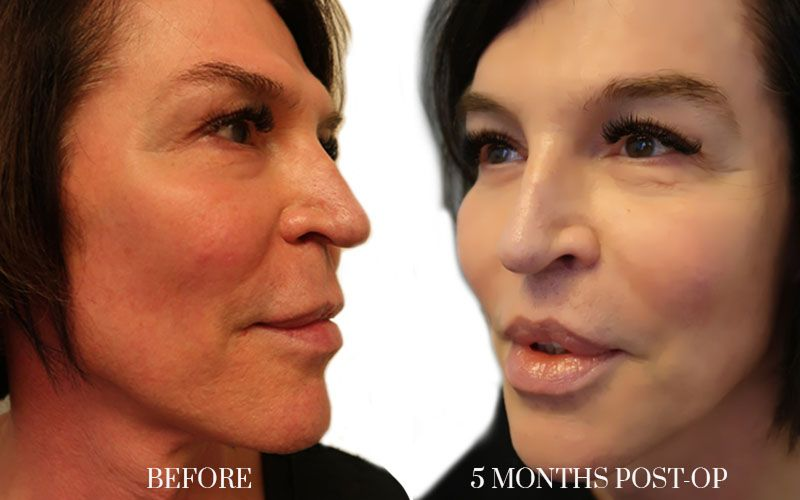 antes y despues FEMINIZACION-FACIAL 2