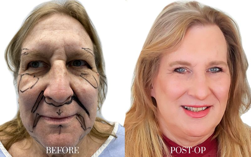 antes y despues FEMINIZACION-FACIAL 3 1