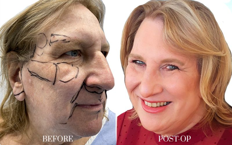 antes y despues FEMINIZACION-FACIAL 4 1