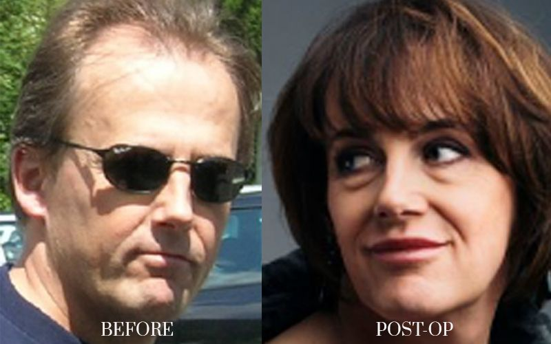 antes y despues FEMINIZACION-FACIAL 5 1