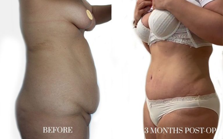 antes-y-después-abdominoplastia-2