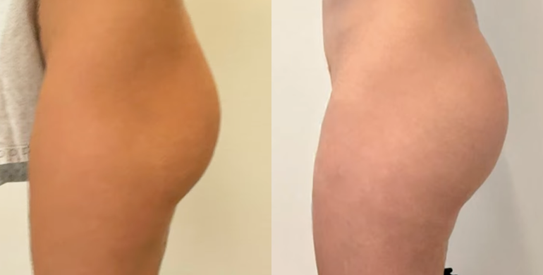 antes-y-después-aumento-de-gluteos-1