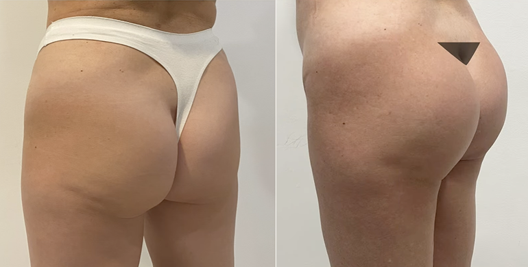 antes-y-después-aumento-de-gluteos-2