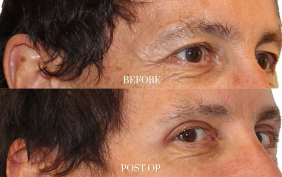 antes y después - blefaroplastia 1 (1)