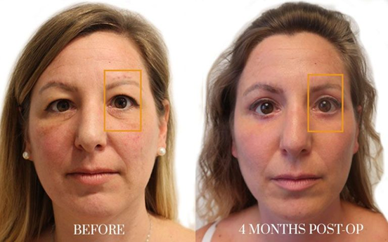 antes y después - blefaroplastia 1