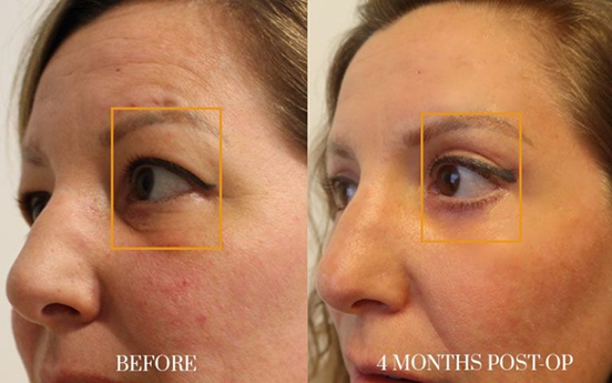 antes y después - blefaroplastia 2