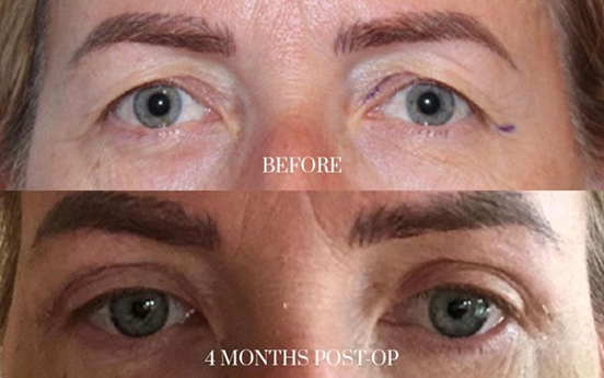 antes y después - blefaroplastia 3