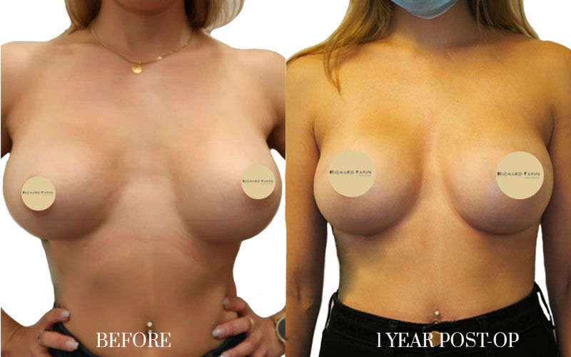 antes y despues cirugia secundaria