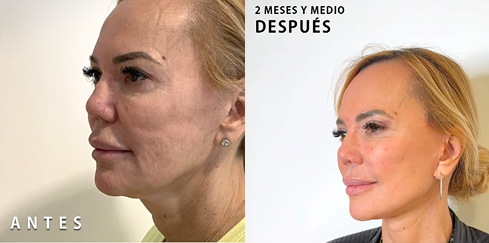 antes-y-después-lifting-facial (1)
