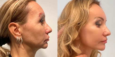 antes-y-después-lifting-facial