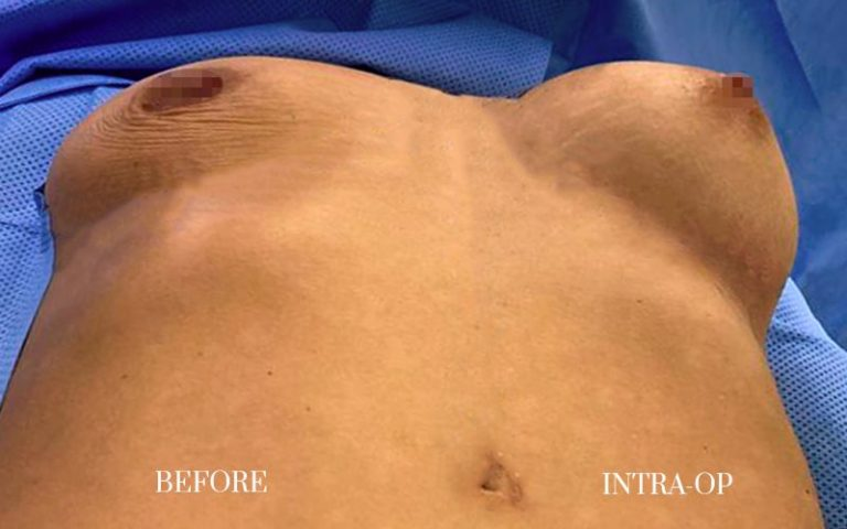 antes-y-después-lipofilling-corporal-1