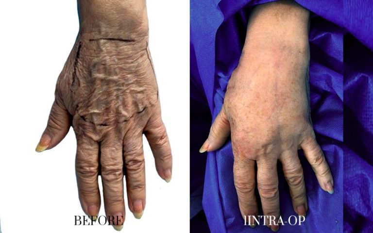 antes-y-después-lipofilling-corporal-2