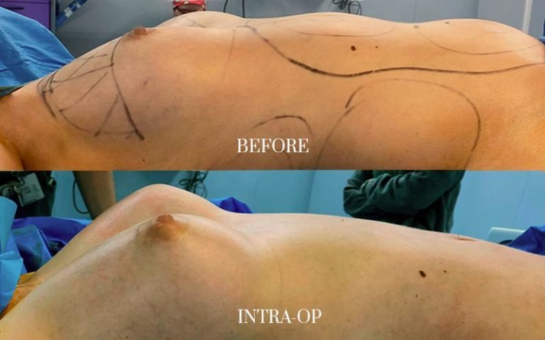 antes-y-después-lipofilling-corporal-4