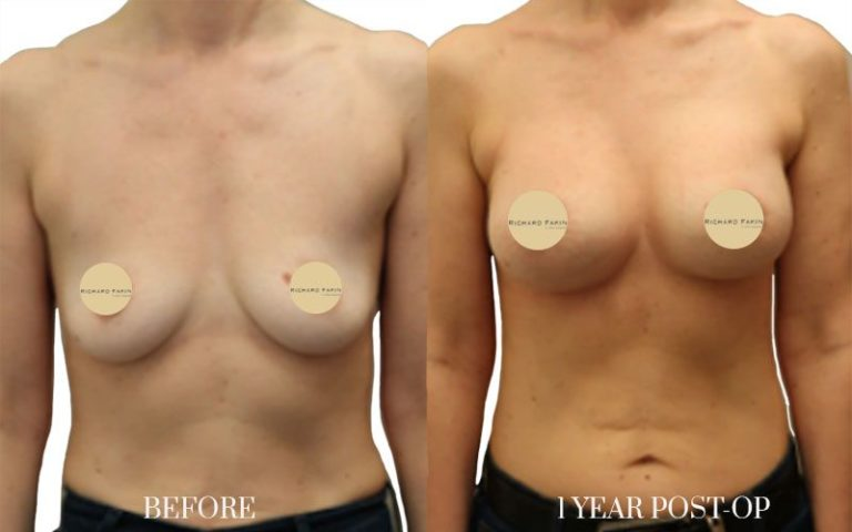 antes-y-después-lipofilling-mamario-1