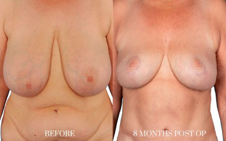 antes-y-después-lipofilling-mamario-2