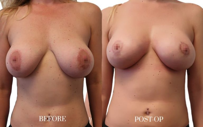 antes-y-después-lipofilling-mamario-3