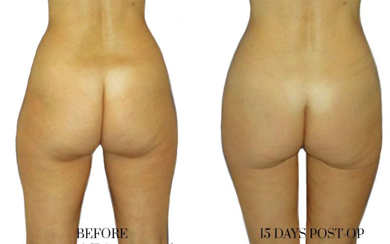 before-and-after-liposuction-1