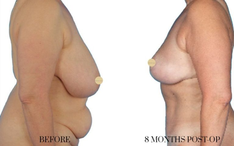 before-and-after-liposuction-2