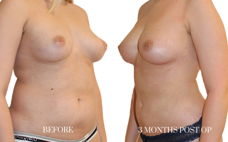 before-and-after-liposuction-4
