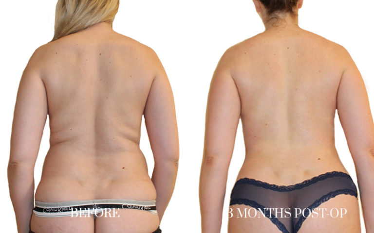 before-and-after-liposuction-5