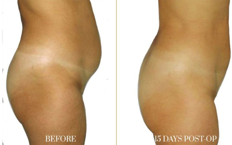 before-and-after-liposuction-6