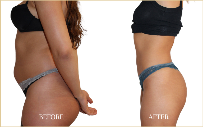 before-and-after-liposuction-7