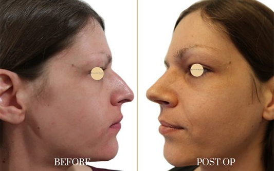 antes-y-después-rinoplastia-2