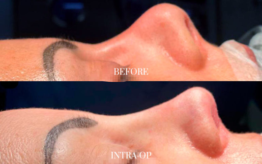 antes-y-después-rinoplastia-3