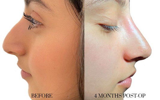 antes-y-después-rinoplastia