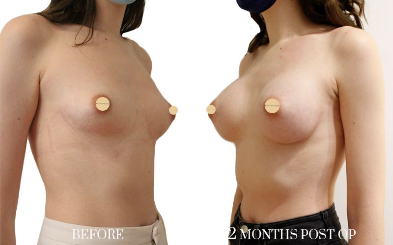 aumento-de-pecho-2L 1