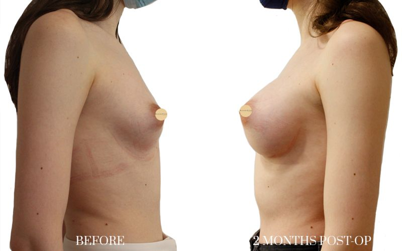 aumento-de-pecho-3L 1