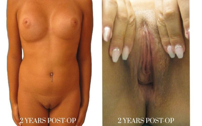 vaginoplasty-before-and-after-2