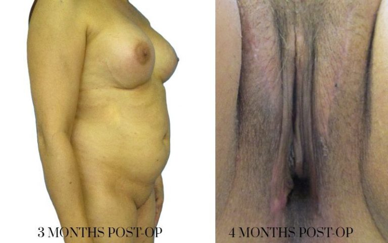 vaginoplasty-before-and-after-4