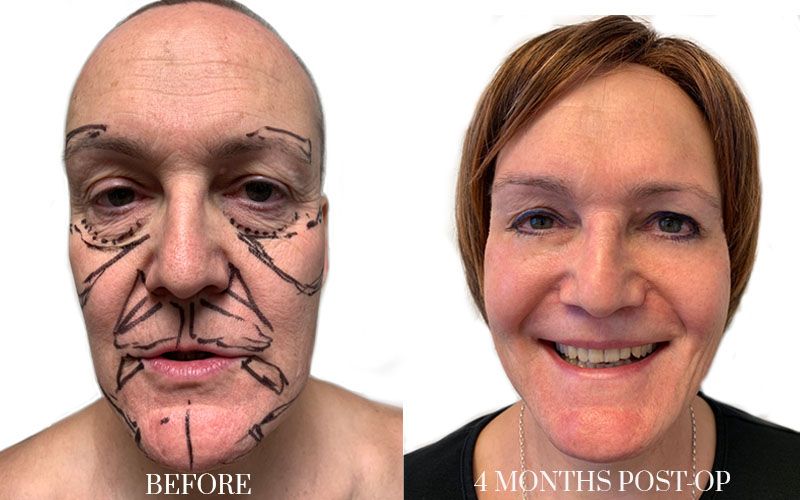 Before and after facial feminisation surgery FFS with preoperative marking and final result