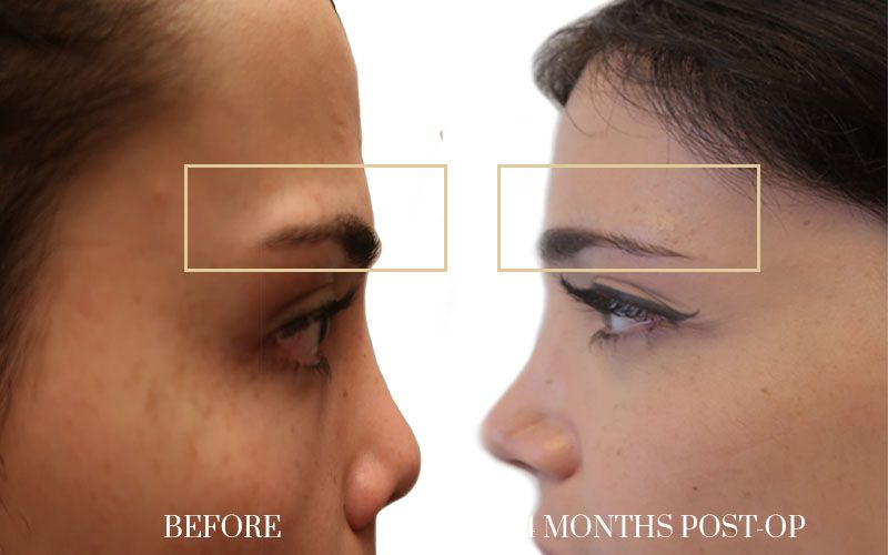 Before and after FFS forehead surgery with eyebrow and hairline modification