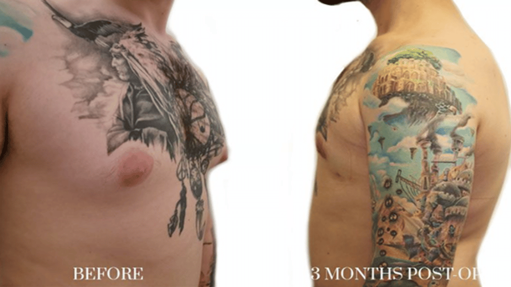 Antes y después de cirugía de ginecomastia realizada por el Dr. Richard Fakin