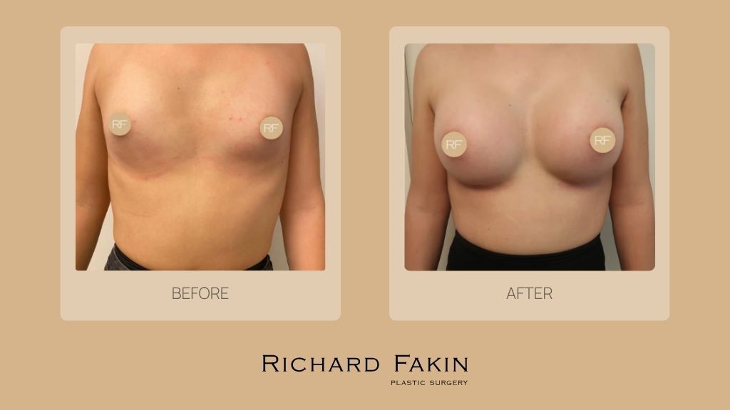 Before and after breast augmentation surgery for a transgender woman performed by Dr. Richard Fakin