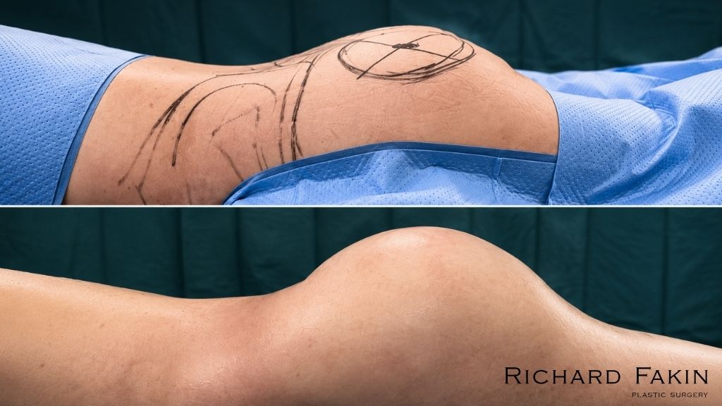 Pre-operative and intra-operative comparison of buttock augmentation