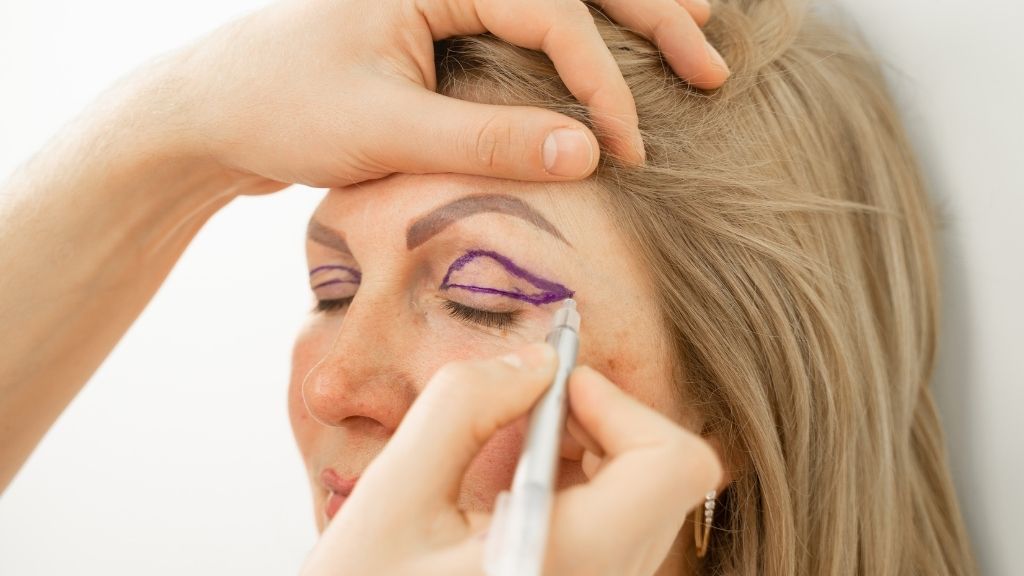 Marcaje preoperatorio para una blefaroplastia